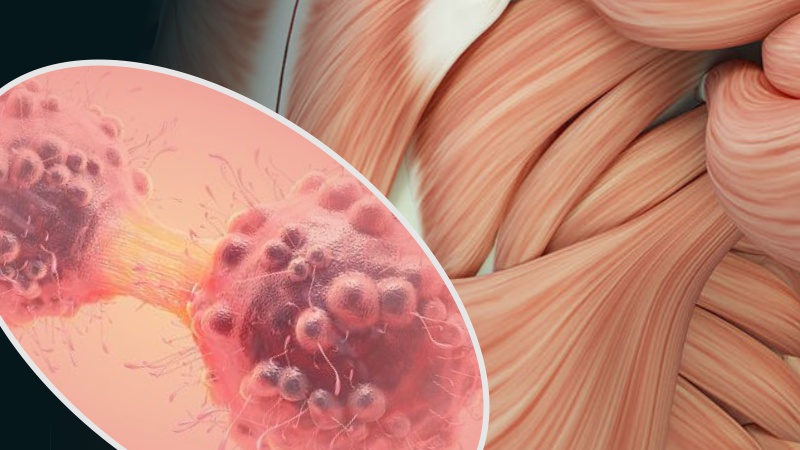 Musculoskeletal Complications of Cancer and its Treatments